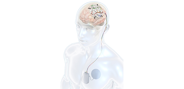 QV Bioelectronics awarded £1.26M grant to advance new treatment for brain cancer
